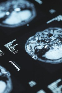 When is an Injury Considered Catastrophic?