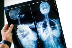 What Does Life Look Like for Those with a Spinal Cord Injury?