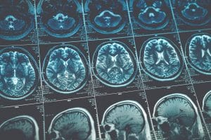 New Blood Test Could Lead to Faster Brain Injury Diagnosis in Babies