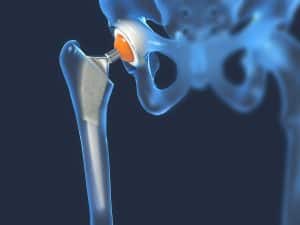 Exactech Recalls Hip, Knee, and Ankle Replacements 