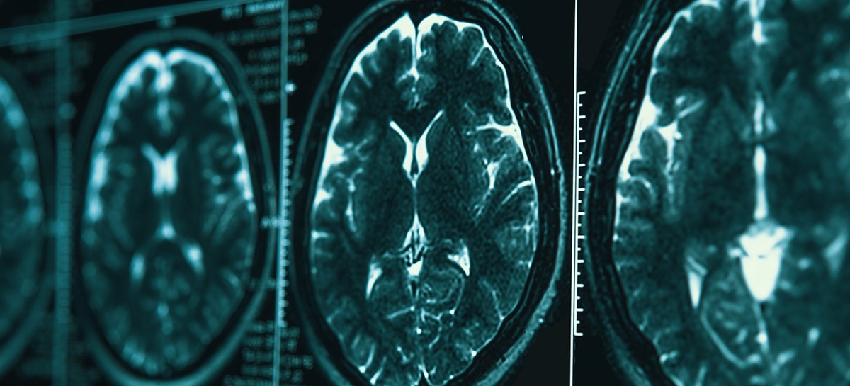 brain-injury brain-injury